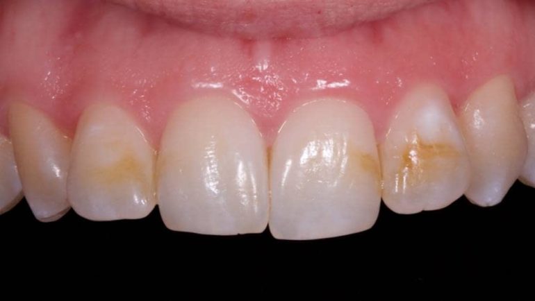 ¿Sabes Qué Es La Fluorosis Dental? Te Contamos Como Prevenirla Y Su ...