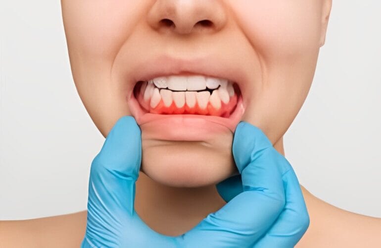 Un destista de la clínica dental en Valladolid, clínica MYM con guantes azules sostiene suavemente las mejillas de un paciente para examinar las encías inflamadas y rojizas porque tiene dolor de encías.