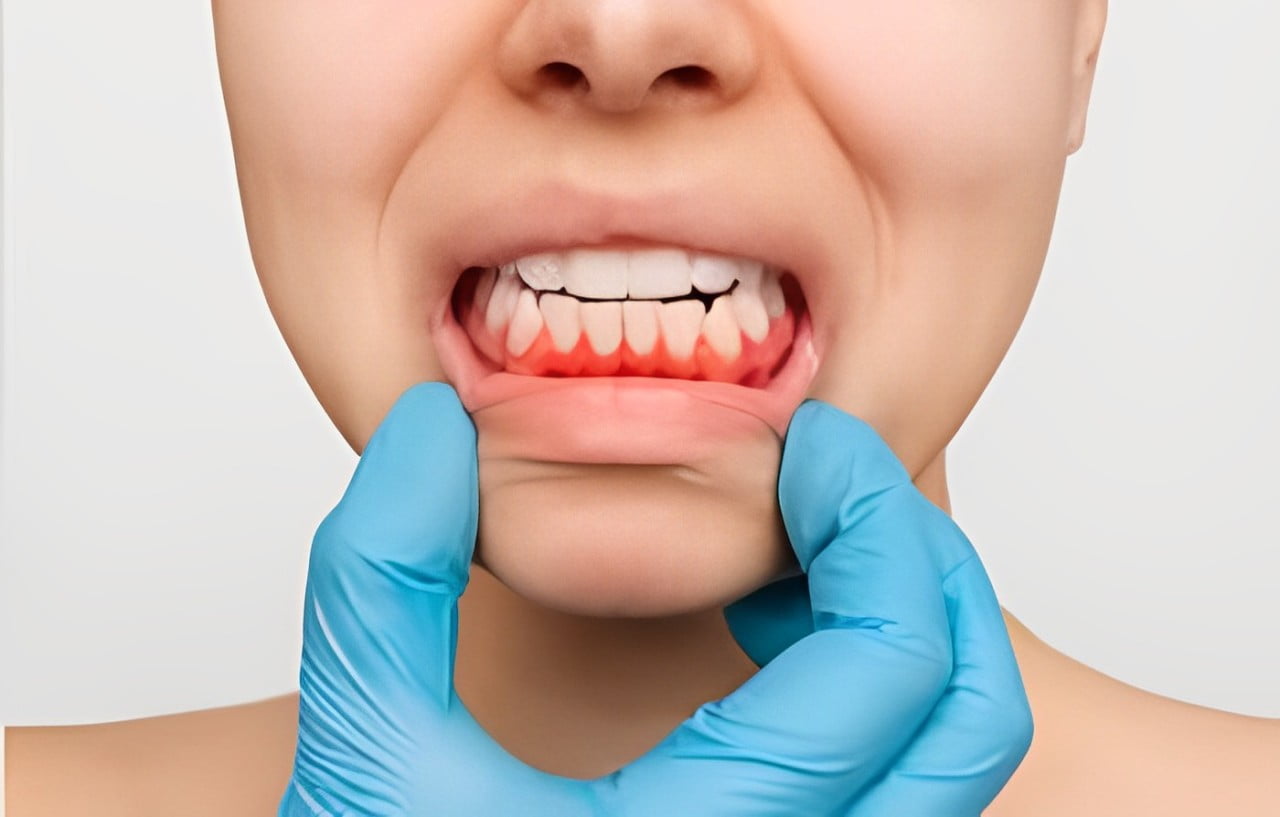 Un destista de la clínica dental en Valladolid, clínica MYM con guantes azules sostiene suavemente las mejillas de un paciente para examinar las encías inflamadas y rojizas porque tiene dolor de encías.